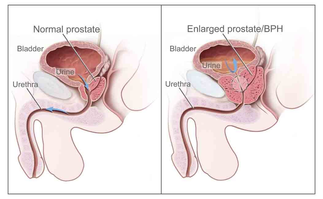 Prostatic Hyperplasia Symptoms