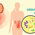 Urinary Tract Infections