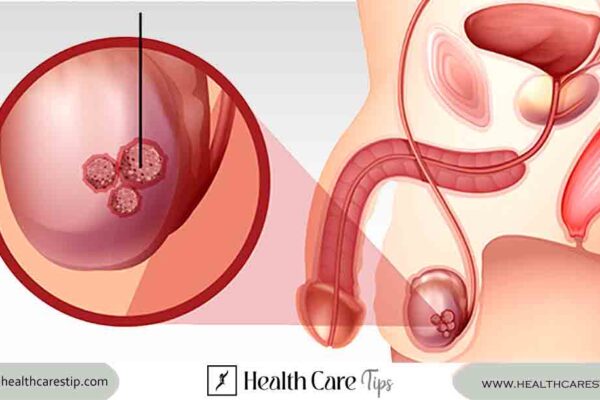 Testicular Cancer Symptoms | Early detection and awareness