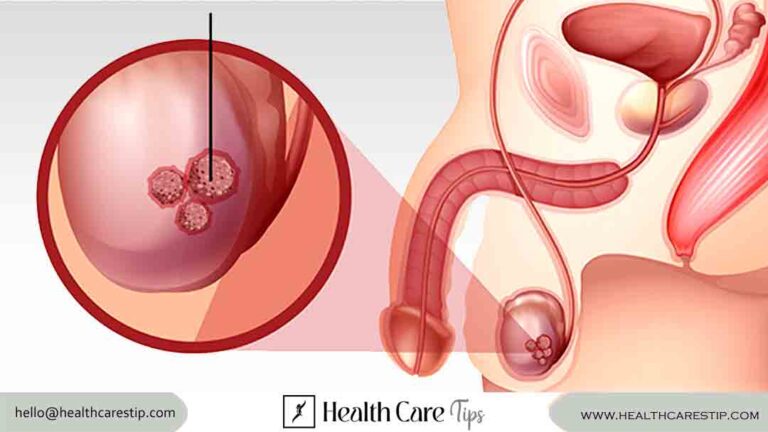 testicular cancer symtoms