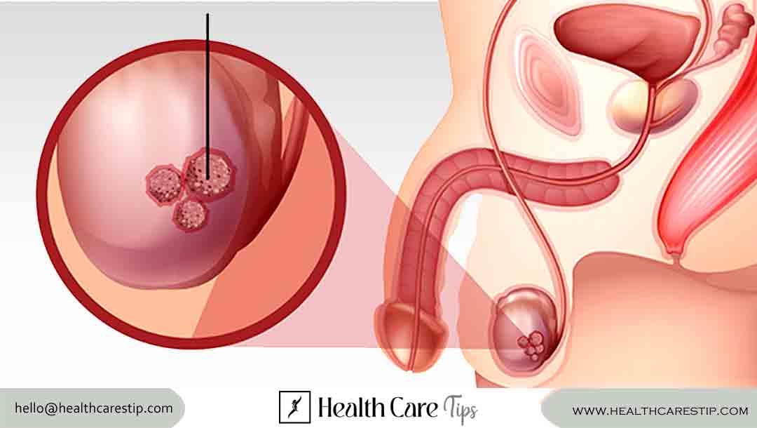 Testicular Cancer Symptoms | Early detection and awareness