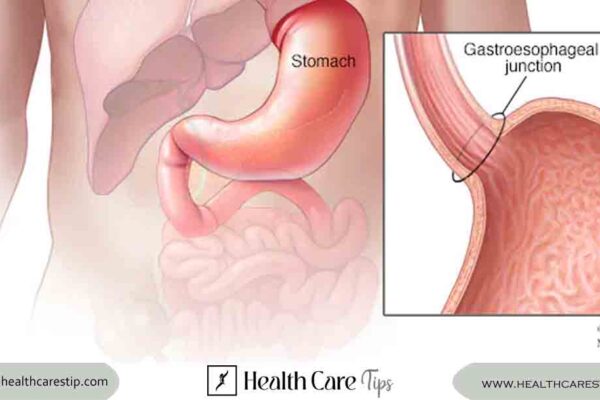 stomach cancer symptoms | Early Signs, Diagnosis, and Treatment