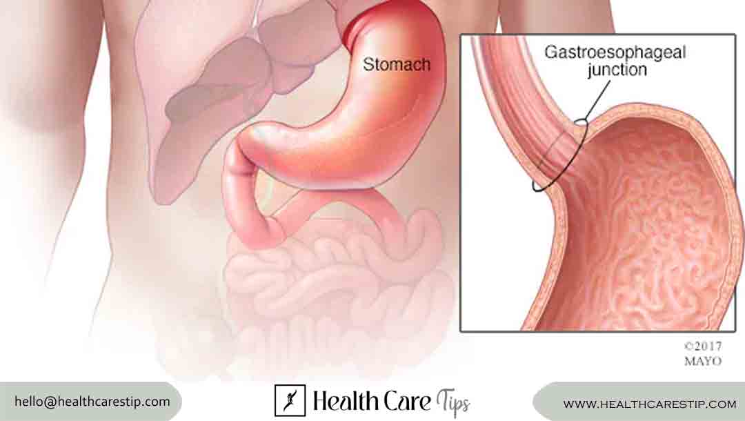 stomach cancer symptoms | Early Signs, Diagnosis, and Treatment