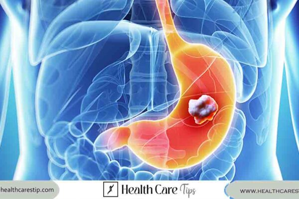 stomach cancer treatment | Symptoms, Diagnosis