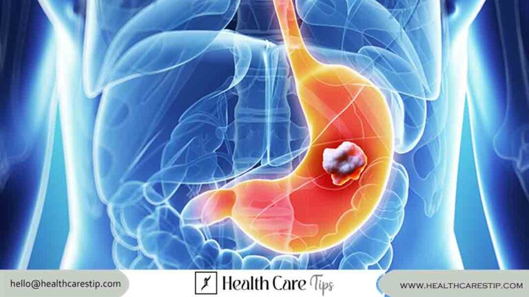 stomach cancer treatment