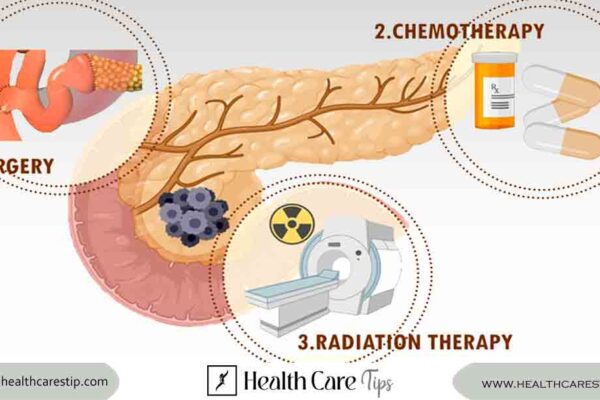 pancreatic cancer treatment | Diagnosis, Treatment, and Support