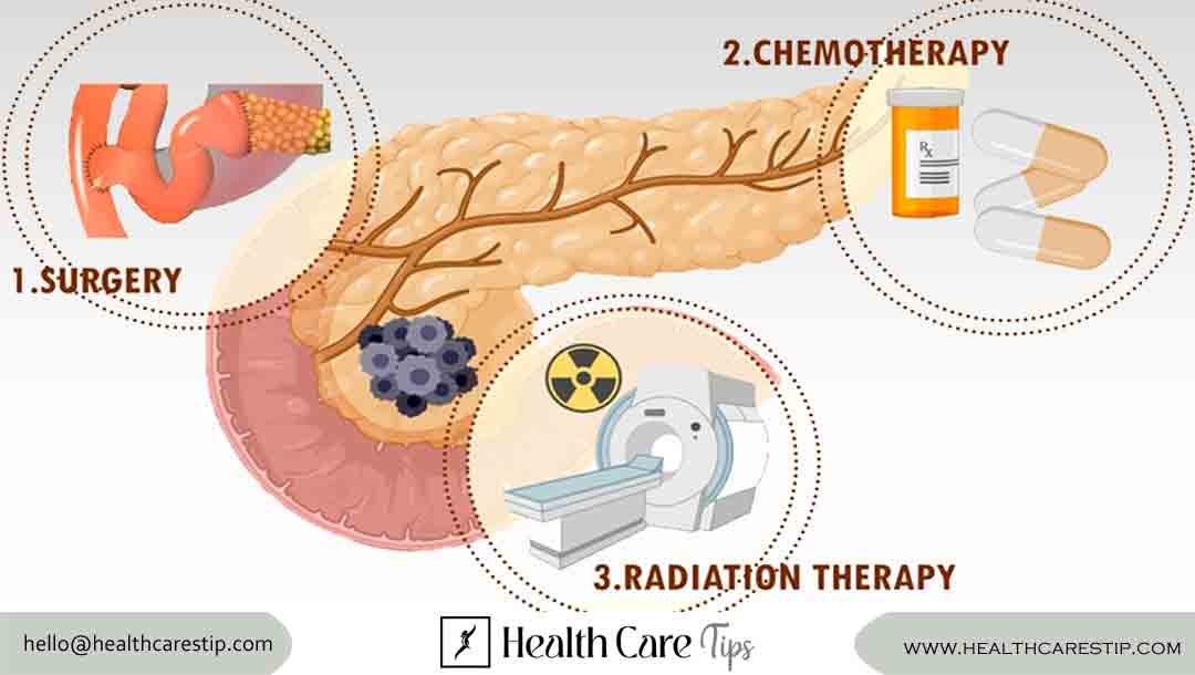 pancreatic cancer treatment | Diagnosis, Treatment, and Support